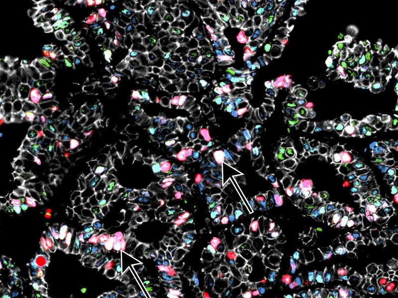 Temporal and spatial topography of cell proliferation in cancer