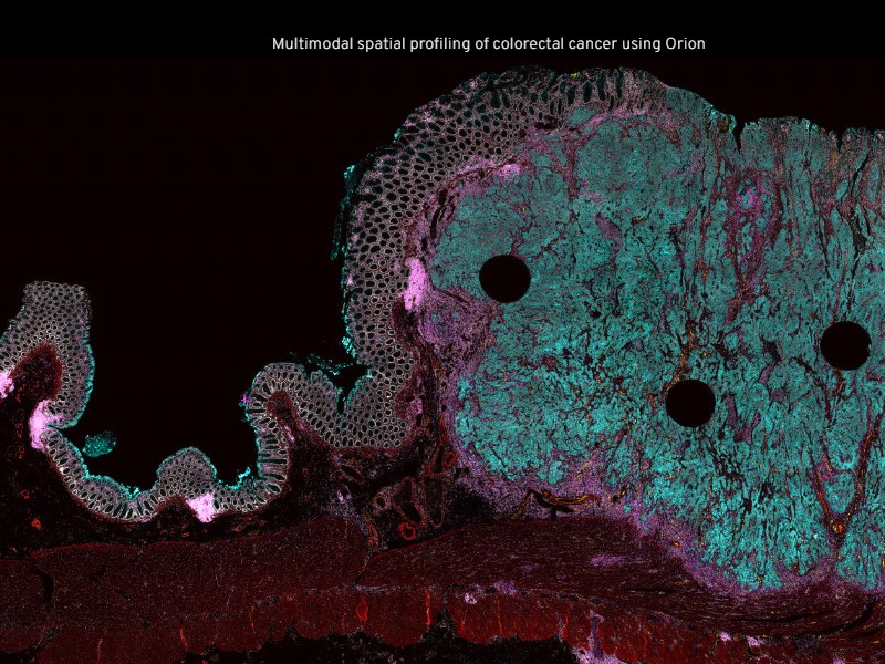 Multimodal spatial profiling of colorectal cancer using Orion