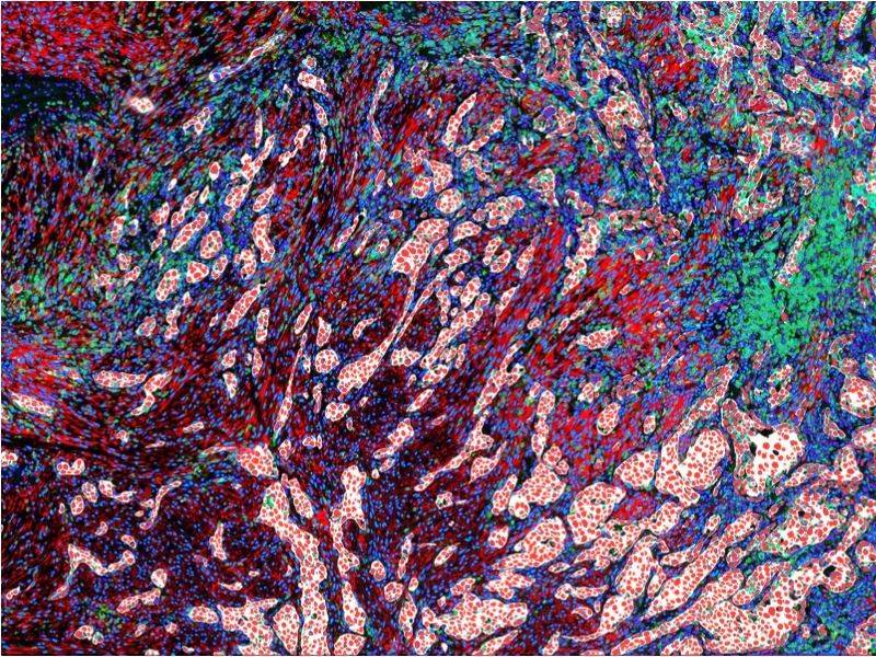 Primary Lung Cancer (Histology)