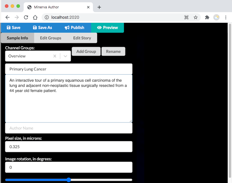 Minerva Author prompts user to enter sample title and description. Example sample title is 'Primary Lung Cancer'. Example description reads 'An interactive tour of a primary squamous cell carcinoma of lung and adjacent non-neoplastic tissue surgically resected from a 44 year old female patient.'.